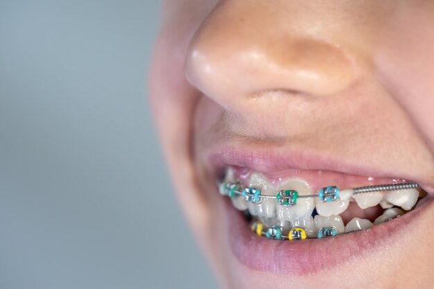 Poradnik pacjenta – jak dbać o zęby podczas leczenia ortodontycznego Invisalign?